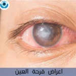 اعراض قرحة العين