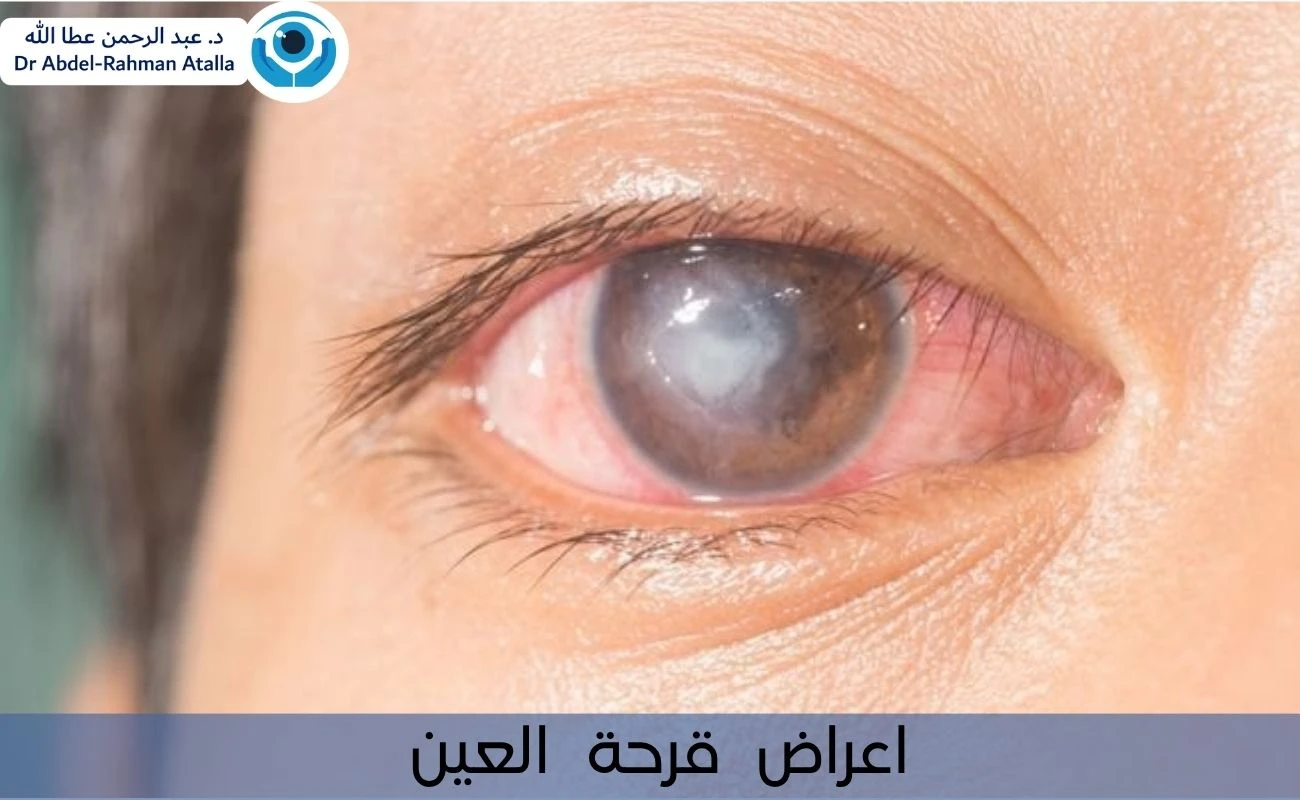 اعراض قرحة العين : خطر يهدد بصرك ولا يحتمل التأجيل