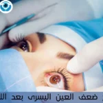 ضعف العين اليسرى بعد الليزك