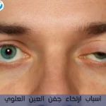 أسباب ارتخاء جفن العين العلوي