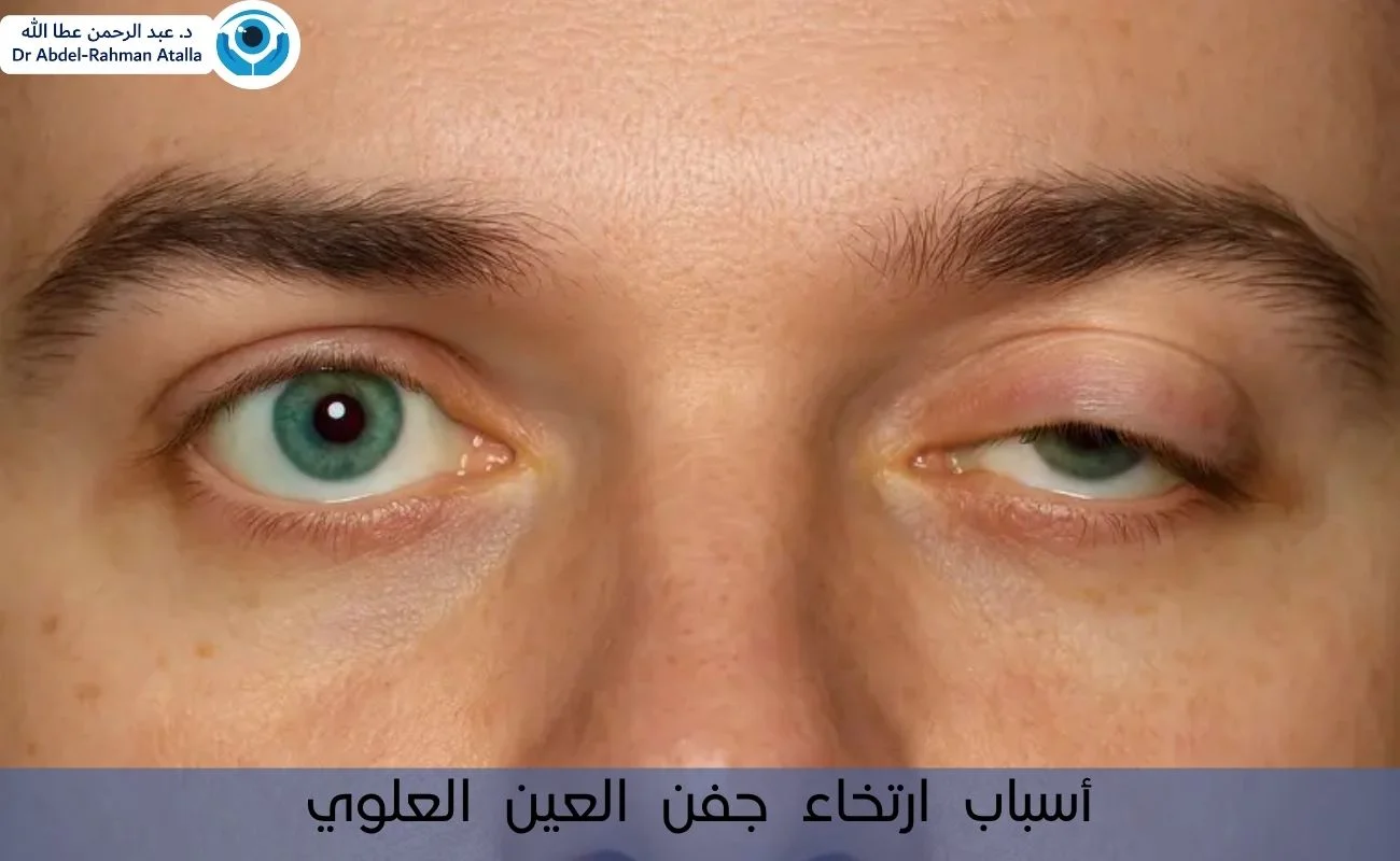 أسباب ارتخاء جفن العين العلوي