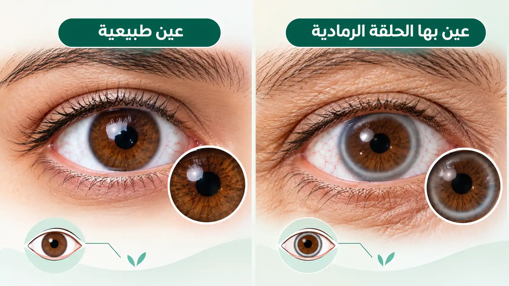 أسباب ظهور لون رمادي حول عدسة العين