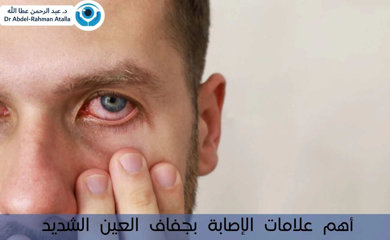 أهم علامات الإصابة بجفاف العين الشديد