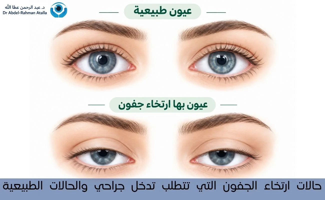 حالات ارتخاء الجفون التي تتطلب تدخل جراحي والحالات الطبيعية