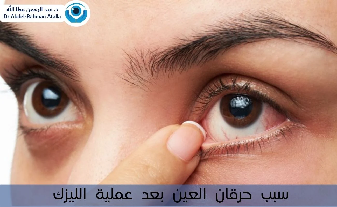 سبب حرقان العين بعد عملية الليزك ومتى يجب زيارة الطبيب؟