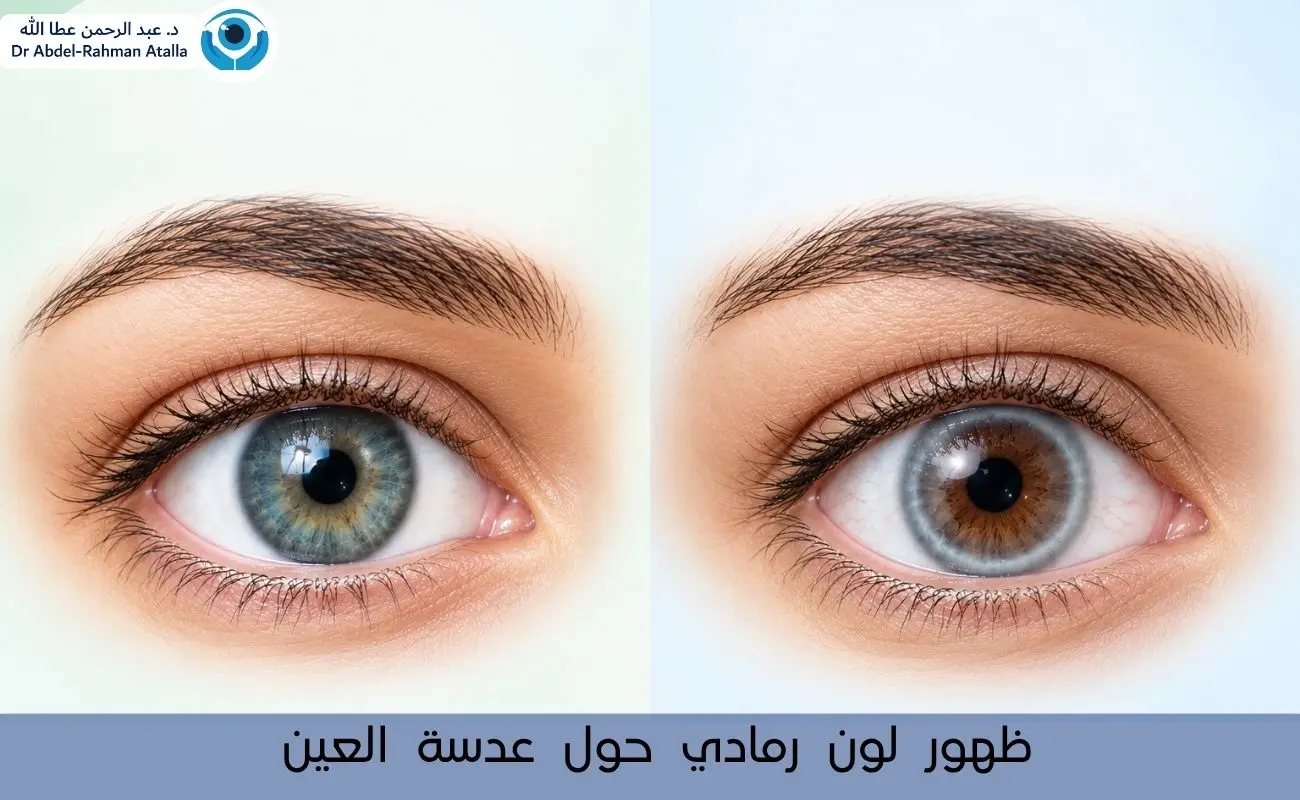 ظهور لون رمادي حول عدسة العين