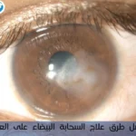 علاج السحابة البيضاء على العين