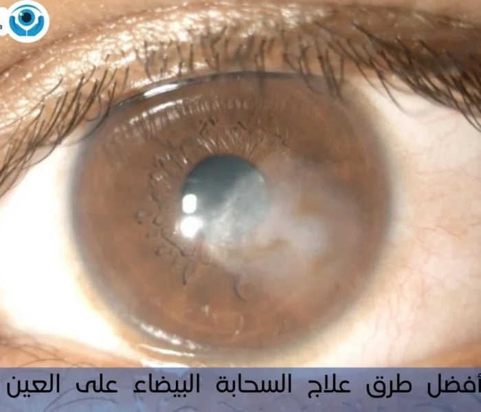 علاج السحابة البيضاء على العين