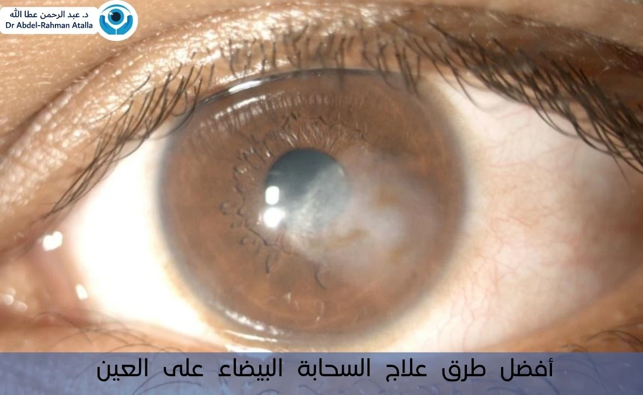 أفضل طرق علاج السحابة البيضاء على العين والأسباب الطبية