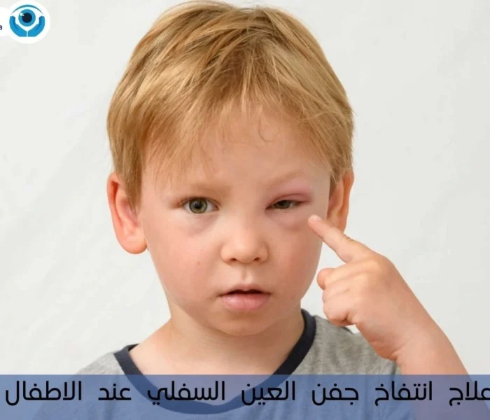 علاج انتفاخ جفن العين السفلي عند الاطفال