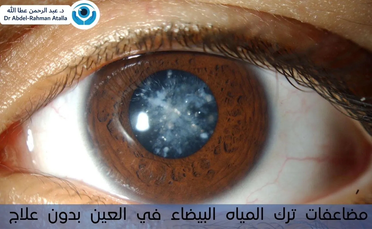 مضاعفات ترك المياه البيضاء في العين بدون علاج
